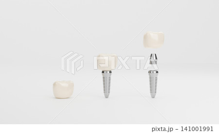 Clean 3D illustration showing dental implant assembly stages with ceramic crowns, metal abutments, and titanium screws on white background Clean 3D illustration showing dental implant assembly stages with ceramic crowns, metal abutments, and titanium screws on white background 141001991