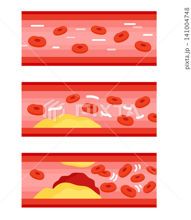 健康な血管と動脈硬化・血栓の比較イラストセット 健康な血管と動脈硬化・血栓の比較イラストセット 141004748