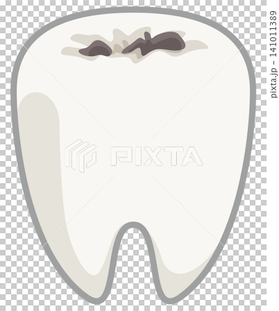 Illustration of a tooth with decay 141011389