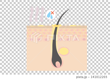 Cross-sectional illustration of a scalp with excessive sebum secretion due to dryness. Cross-sectional illustration of a scalp with excessive sebum secretion due to dryness. 141012203
