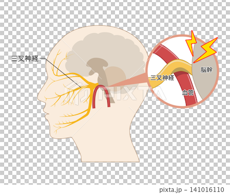 Diagram illustrating the mechanism by which blood vessels compress the trigeminal nerve, causing pain (medical and anatomical reference material) Diagram illustrating the mechanism by which blood vessels compress the trigeminal nerve, causing pain (medical and anatomical reference material) 141016110