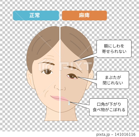 圖示對比臉部不對稱和顏面神經麻痺引起的症狀。 圖示對比臉部不對稱和顏面神經麻痺引起的症狀。 141016116