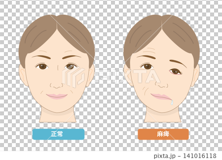 圖示對比臉部不對稱和顏面神經麻痺引起的症狀。 圖示對比臉部不對稱和顏面神經麻痺引起的症狀。 141016118