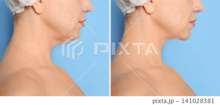 Mature woman before and after plastic surgery operation on blue background, closeup Mature woman before and after plastic surgery operation on blue background, closeup 141028381
