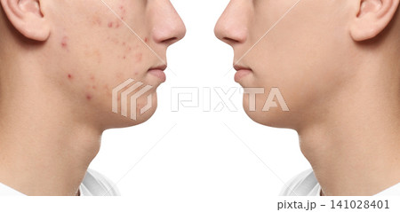 Teenager before and after acne treatment on white background, closeup Teenager before and after acne treatment on white background, closeup 141028401