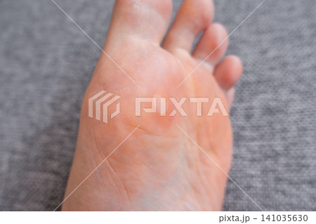 Blister on Human Foot Isolated on Neutral Background 141035630