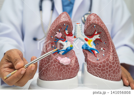 Pneumonia, lung cancer, Asian doctor with human lung model. Pneumonia, lung cancer, Asian doctor with human lung model. 141056808