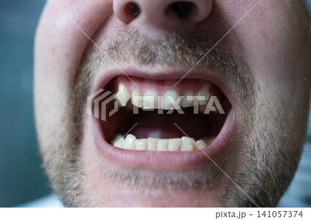 man with open mouth smiling in indoor setting with white teeth and pink mustache, close-up view of happy expression in healthcare and dentistry context, for editorial and web. man with open mouth smiling in indoor setting with white teeth and pink mustache, close-up view of happy expression in healthcare and dentistry context, for editorial and web. 141057374
