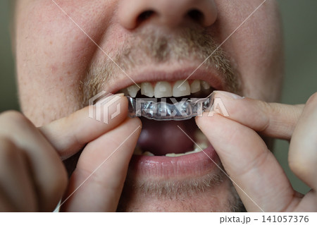 man inserting clear aligner into mouth in neutral indoor setting with beige beard and skin tones, close-up view of face and hands, dental care professional context. man inserting clear aligner into mouth in neutral indoor setting with beige beard and skin tones, close-up view of face and hands, dental care professional context. 141057376