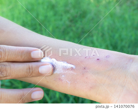 Hand with urticaria allergy itchy rash eczema itch woman from food,grass,Air poisoning,cosmetic,health,body care disease lilness air,dissease medicine calamine Lotion Treatment ,infection pain scratch Hand with urticaria allergy itchy rash eczema itch woman from food,grass,Air poisoning,cosmetic,health,body care disease lilness air,dissease medicine calamine Lotion Treatment ,infection pain scratch 141070076