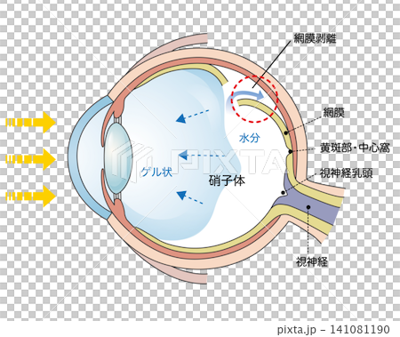 視網膜剝離示意圖 141081190