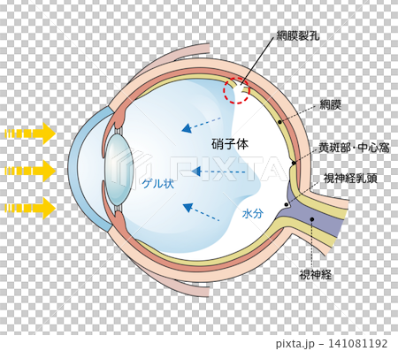 視網膜撕裂示意圖。 視網膜撕裂示意圖。 141081192