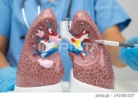 Pneumonia, lung cancer, Asian doctor with human lung model. Pneumonia, lung cancer, Asian doctor with human lung model. 141085107