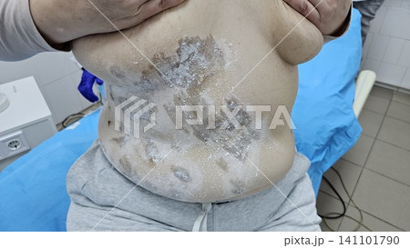 Professional removal of papillomas and moles with electrocoagulation procedure in dermatology clinic. overweight European woman on the surgical table. moles papillomas neoplasms on the body Professional removal of papillomas and moles with electrocoagulation procedure in dermatology clinic. overweight European woman on the surgical table. moles papillomas neoplasms on the body 141101790
