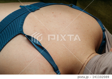 Macro close-up of a benign nevus or papilloma on Caucasian skin. Small benign mole on the upper back of a Caucasian woman. Macro close-up of a benign nevus or papilloma on Caucasian skin. Small benign mole on the upper back of a Caucasian woman. 141102089