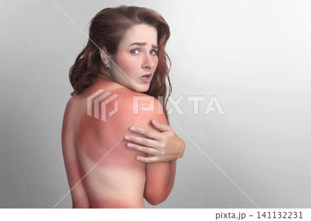 A beautiful woman with red skin burnt in the sun on her back. Swimsuit skin marks. Woman touches red sunburned back. Skin irritation from sun exposure needs care. 141132231