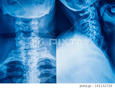 X-Ray Image of human neck for a medical diagnosis. X-Ray Image of human neck for a medical diagnosis. 141132726