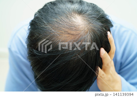Bald head in man, hair loss treatment health problem. 141139394