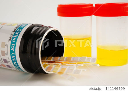 Urinalysis, urine cup with reagent strip pH paper test and comparison chart in laboratory. Urinalysis, urine cup with reagent strip pH paper test and comparison chart in laboratory. 141146599