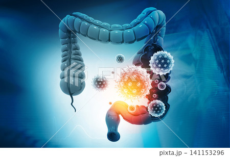 Colon cancer, bacterias, viruses in sick unhealthy intestine 141153296