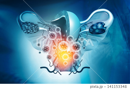 Uterus infection concept Uterus infection concept 141153348