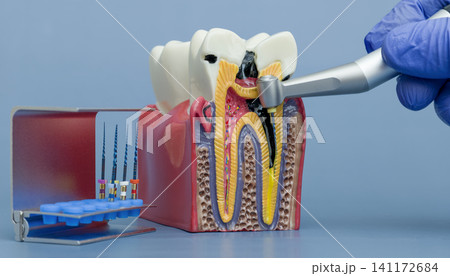 Endodontics concept. Educational anatomical model of a tooth with deep caries and pulpitis treatment demonstration. Endodontics concept. Educational anatomical model of a tooth with deep caries and pulpitis treatment demonstration. 141172684
