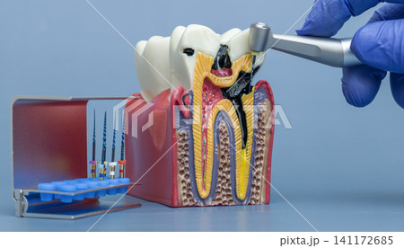 Dentist hand in blue glove demonstrating root canal treatment on a tooth cross-section model with endodontic files. Dentist hand in blue glove demonstrating root canal treatment on a tooth cross-section model with endodontic files. 141172685