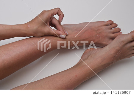 Female hands carefully exfoliating sun-damaged skin on legs, demonstrating detailed skincare routine and healing after sun overexposure. Female hands carefully exfoliating sun-damaged skin on legs, demonstrating detailed skincare routine and healing after sun overexposure. 141186907