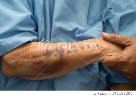 Ecchymosis, elderly bleeding on her arm after taking aspirin. 141192203