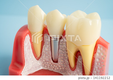 Dental implant, artificial tooth roots into jaw, root canal of dental treatment, gum disease, teeth model for dentist studying about dentistry. Dental implant, artificial tooth roots into jaw, root canal of dental treatment, gum disease, teeth model for dentist studying about dentistry. 141192212