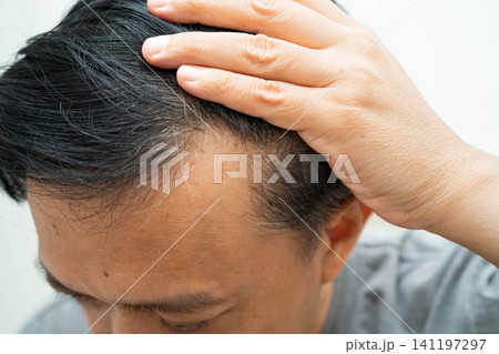 Bald head in man, hair loss treatment health problem. Bald head in man, hair loss treatment health problem. 141197297