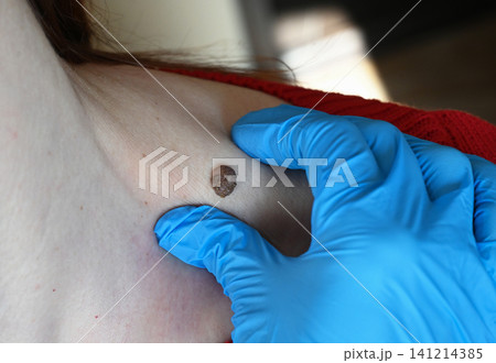 removing a large mole on a patient s neck with a medical laser. Laser removal of mole Stock Photo removing a large mole on a patient s neck with a medical laser. Laser removal of mole Stock Photo 141214385