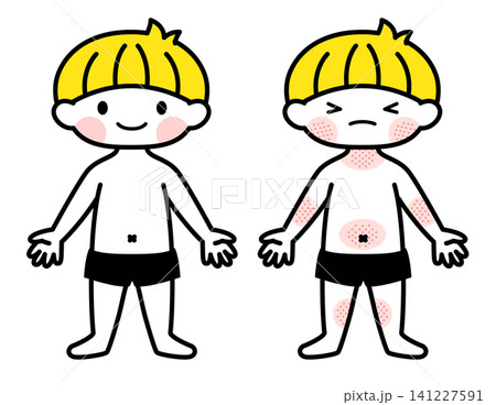 【医療・保育】湿疹（アトピー）の出ている男の子のイラスト 141227591