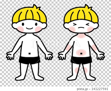 [Medical/Childcare] Illustration of a boy with eczema (atopic dermatitis) 141227591