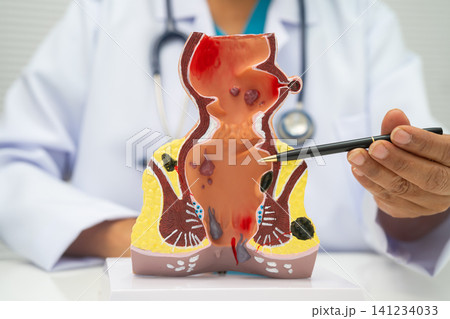 Asian doctor with rectum and hemorrhoid human model, inflamed vascular structure. 141234033