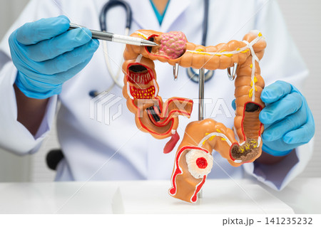 Colorectal cancer, doctor holding intestine colon human anatomy model. Colorectal cancer, doctor holding intestine colon human anatomy model. 141235232
