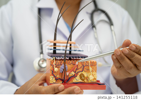 Hair transplant, Asian dermatologist doctor holding skin structure anatomy model for treatment in hospital. 141255118