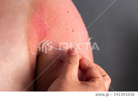 Woman removing old peeling skin after sunburn. UV damage and unprotected tanning consequences visible. Burn recovery process Woman removing old peeling skin after sunburn. UV damage and unprotected tanning consequences visible. Burn recovery process 141301016