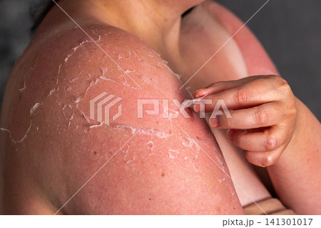 Woman with peeling shoulders from excessive sun. Skin regeneration after burn. Close up of redness and painful wound Woman with peeling shoulders from excessive sun. Skin regeneration after burn. Close up of redness and painful wound 141301017
