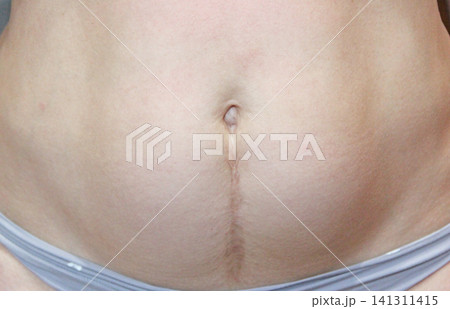 Vertical cesarean section scar on woman abdomen nine years after surgery Vertical cesarean section scar on woman abdomen nine years after surgery 141311415