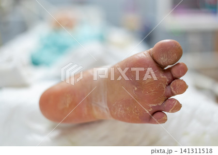 Closeup of dry cracked peeling foot skin showing dehydration callus dermatology condition Healthcare concept selective focus clinical setting Closeup of dry cracked peeling foot skin showing dehydration callus dermatology condition Healthcare concept selective focus clinical setting 141311518
