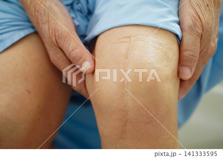 Asian elderly woman patient with scar knee replacement surgery in hospital. Asian elderly woman patient with scar knee replacement surgery in hospital. 141333595