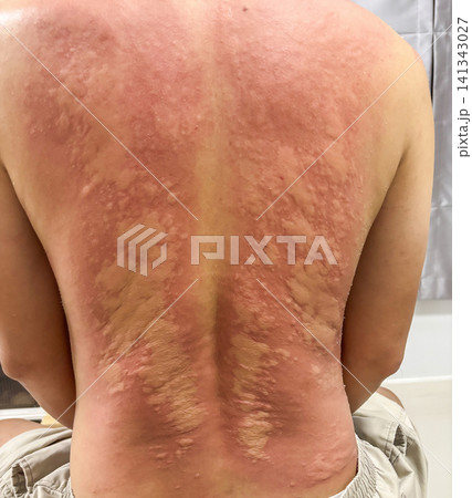 Young asian man itching and scratching on his back from allergic itchy dry skin eczema dermatitis insect bites 141343027