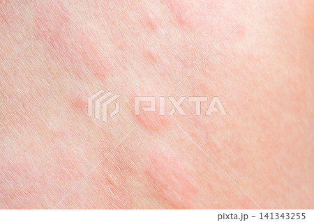 Skin allergy rash dermatitis texture close up background Skin allergy rash dermatitis texture close up background 141343255