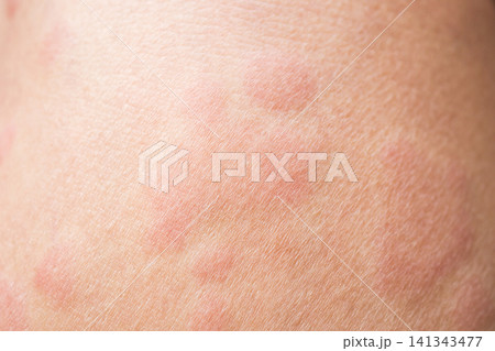 Skin allergy rash dermatitis texture close up background Skin allergy rash dermatitis texture close up background 141343477