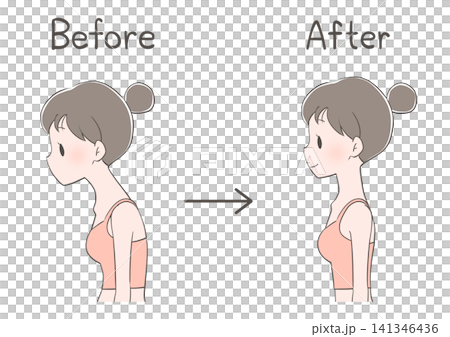 Before and After Photos of a Woman Improving Her Posture (Hunchback/Straight Neck) Before and After Photos of a Woman Improving Her Posture (Hunchback/Straight Neck) 141346436