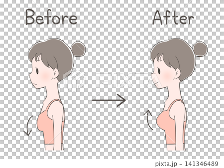 Breast augmentation before and after: Illustration of a woman Breast augmentation before and after: Illustration of a woman 141346489