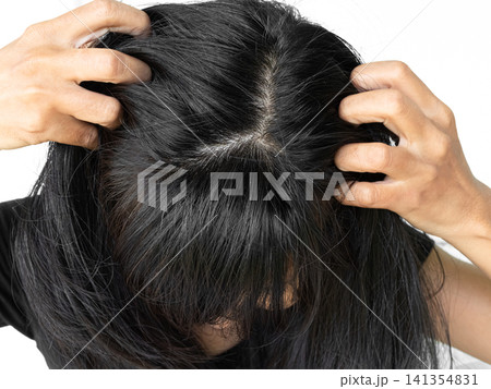 Dandruff Itchy scalp, woman chtatch hair messy she dirty, sensitive disease bacteria dander loss, concept for medicine hyginene champoo treatment skin for good health. Dandruff Itchy scalp, woman chtatch hair messy she dirty, sensitive disease bacteria dander loss, concept for medicine hyginene champoo treatment skin for good health. 141354831