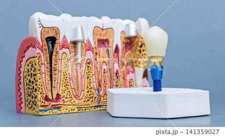 Dental implant model with crown and anatomical cross-section of human jaw showing tooth structure and pathology on a blue background. 141359027