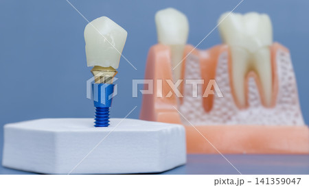dental implant model with ceramic crown. Blurred anatomical jaw cross-section in background. Implantology and prosthodontics concept. dental implant model with ceramic crown. Blurred anatomical jaw cross-section in background. Implantology and prosthodontics concept. 141359047